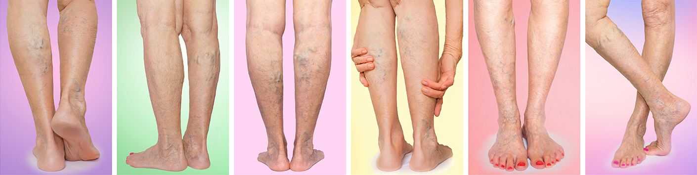Examples of Varicose Veins in legs