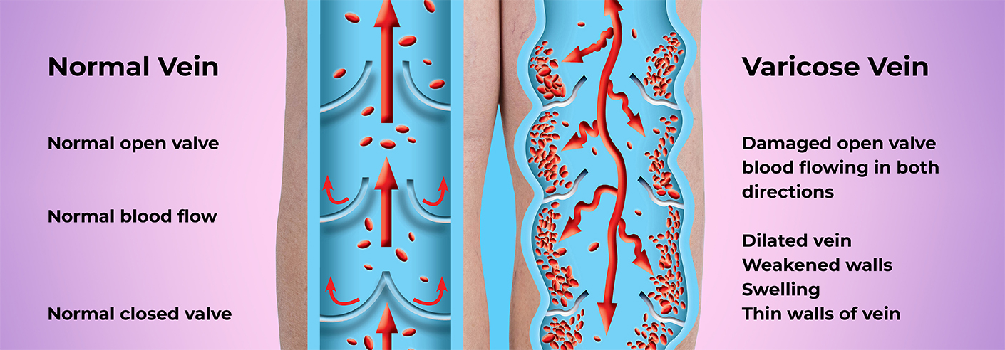 Left: normal vein and blood flow. Right: Varicose (damaged) vein and blood flow.