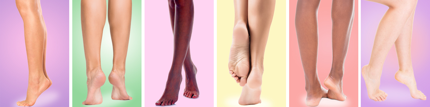Examples of Varicose Veins in legs