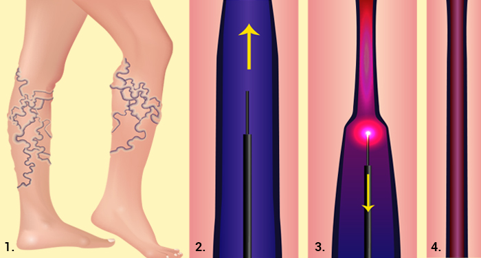 Illustration of the steps involved in endovenous ablation
