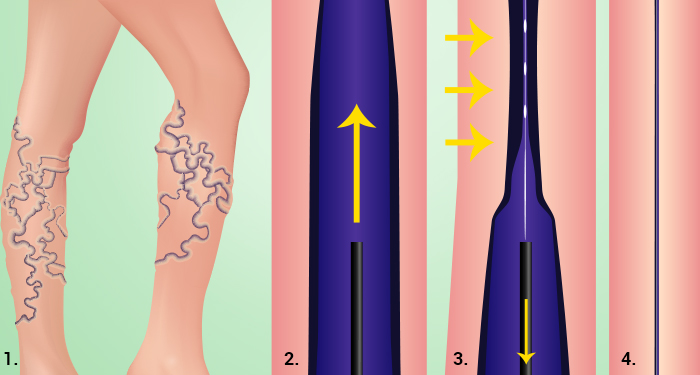 Illustration of the steps involved in venaseal ablation