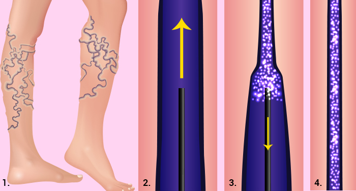 Illustration of the steps involved in Sclerotherapy